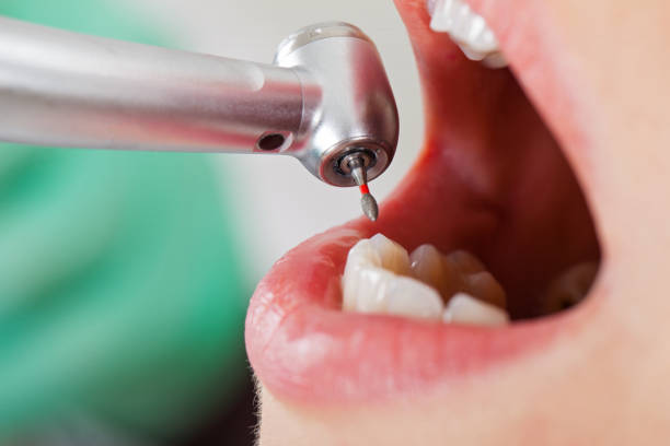 Best Emergency Root Canal Treatment in Albers, IL